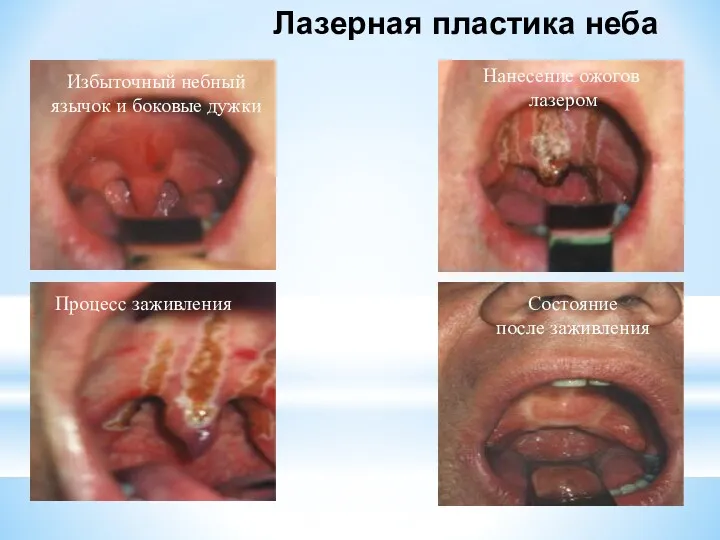 Лазерная пластика неба Избыточный небный язычок и боковые дужки Нанесение