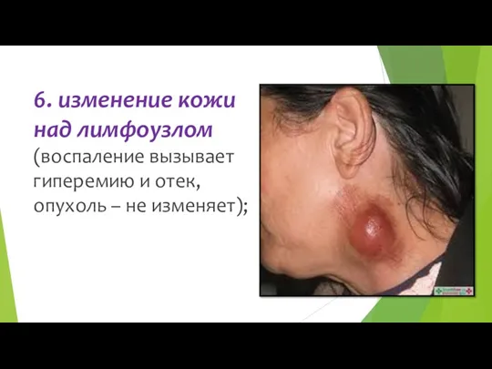 6. изменение кожи над лимфоузлом (воспаление вызывает гиперемию и отек, опухоль – не изменяет);