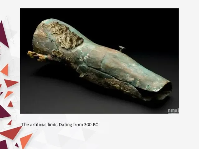 The artificial limb, Dating from 300 BC