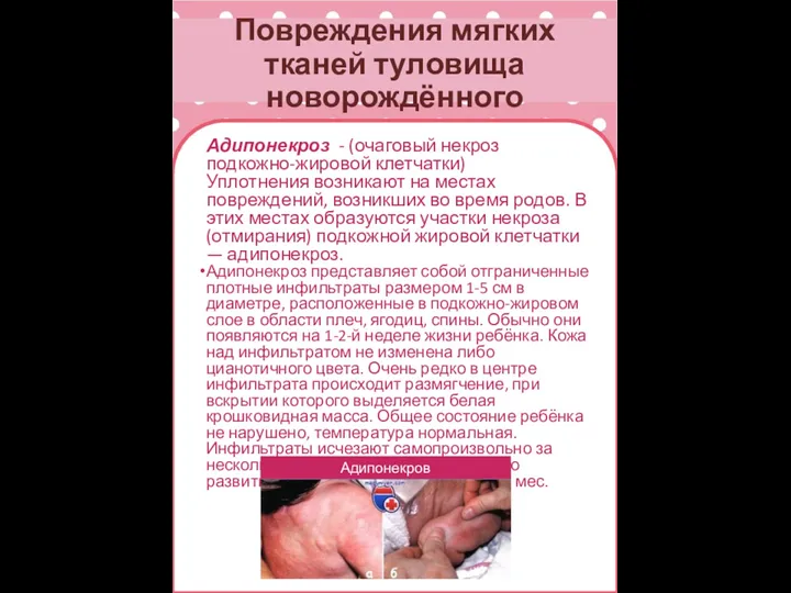 Повреждения мягких тканей туловища новорождённого Адипонекроз - (очаговый некроз подкожно-жировой