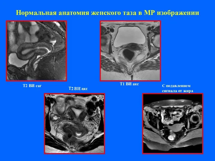 Нормальная анатомия женского таза в МР изображении Т2 ВИ саг