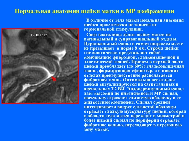 Нормальная анатомия шейки матки в МР изображении В отличие от