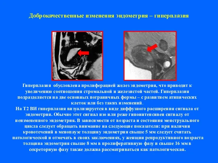 Доброкачественные изменения эндометрия – гиперплазия Гиперплазия обусловлена пролиферацией желез эндометрия,