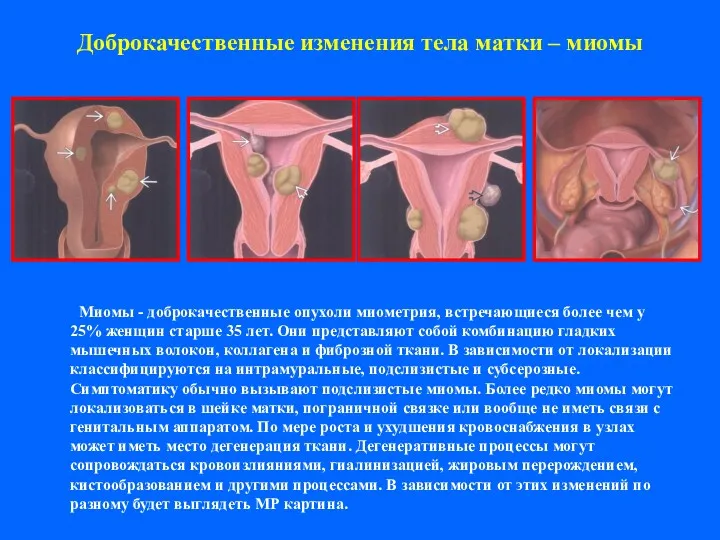 Доброкачественные изменения тела матки – миомы Миомы - доброкачественные опухоли