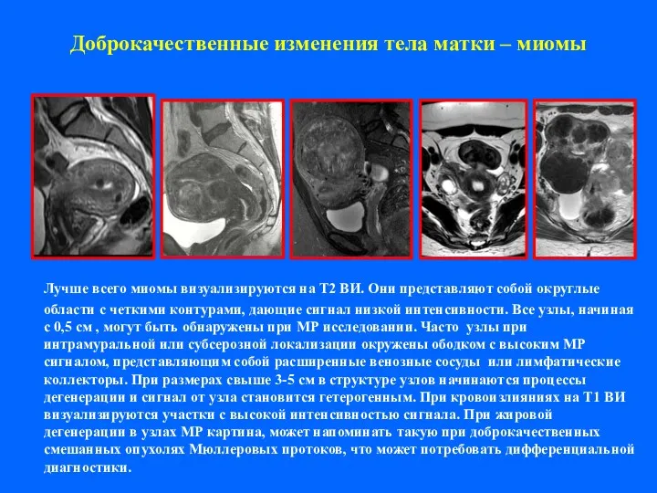 Доброкачественные изменения тела матки – миомы Лучше всего миомы визуализируются