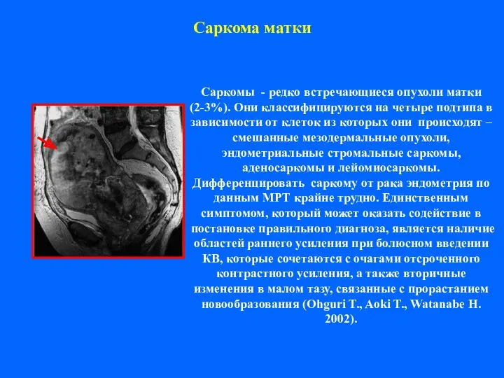 Саркома матки Саркомы - редко встречающиеся опухоли матки (2-3%). Они