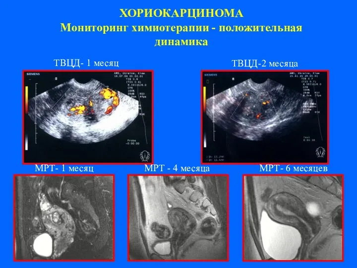 ХОРИОКАРЦИНОМА Мониторинг химиотерапии - положительная динамика TВЦД- 1 месяц TВЦД-2