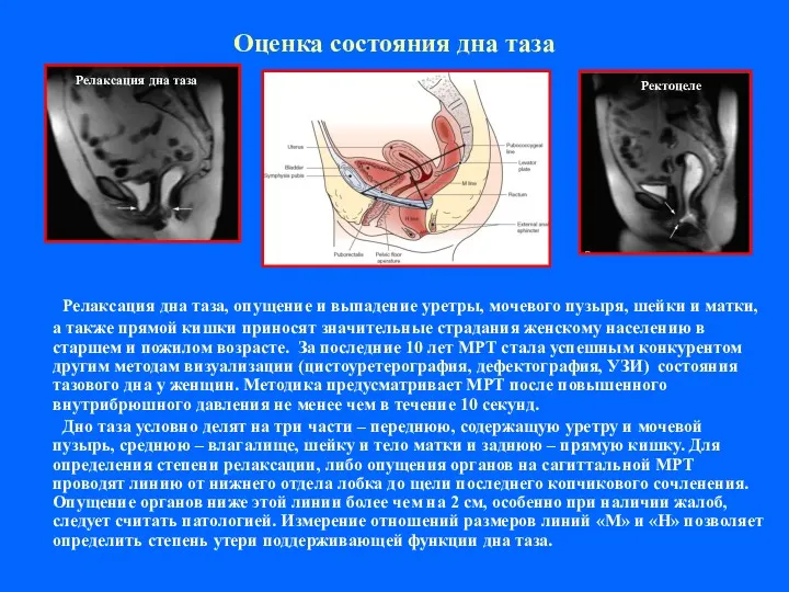 Оценка состояния дна таза Релаксация дна таза, опущение и выпадение