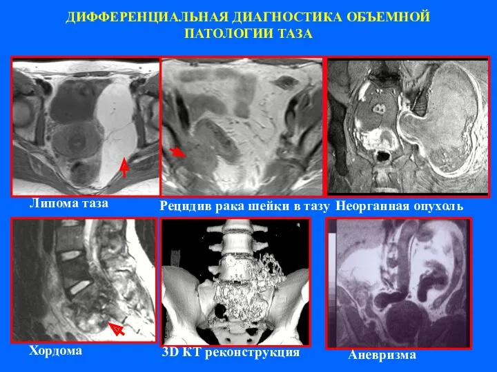 ДИФФЕРЕНЦИАЛЬНАЯ ДИАГНОСТИКА ОБЪЕМНОЙ ПАТОЛОГИИ ТАЗА Липома таза Рецидив рака шейки