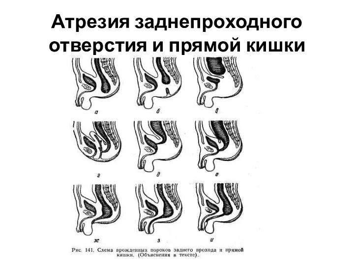 Атрезия заднепроходного отверстия и прямой кишки