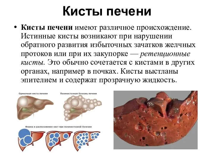 Кисты печени Кисты печени имеют различное происхождение. Истинные кисты возникают