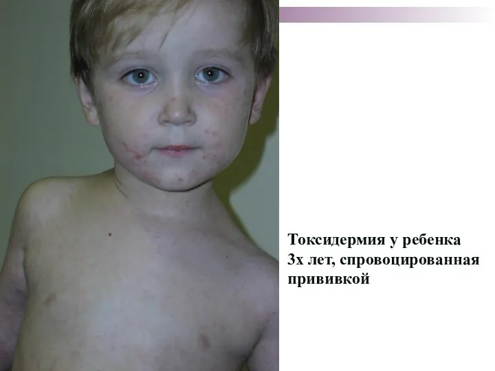 Токсидермия у ребенка 3х лет, спровоцированная прививкой