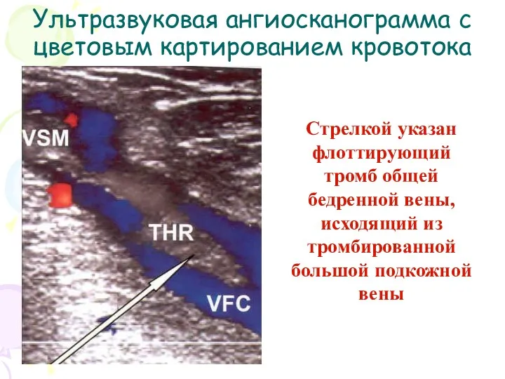 Ультразвуковая ангиосканограмма с цветовым картированием кровотока Стрелкой указан флоттирующий тромб