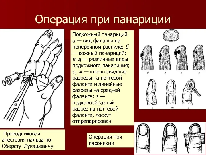 Операция при панариции Проводниковая анестезия пальца по Оберсту–Лукашевичу Подкожный панариций: