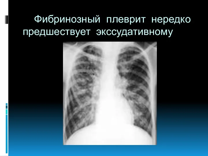 Фибринозный плеврит нередко предшествует экссудативному