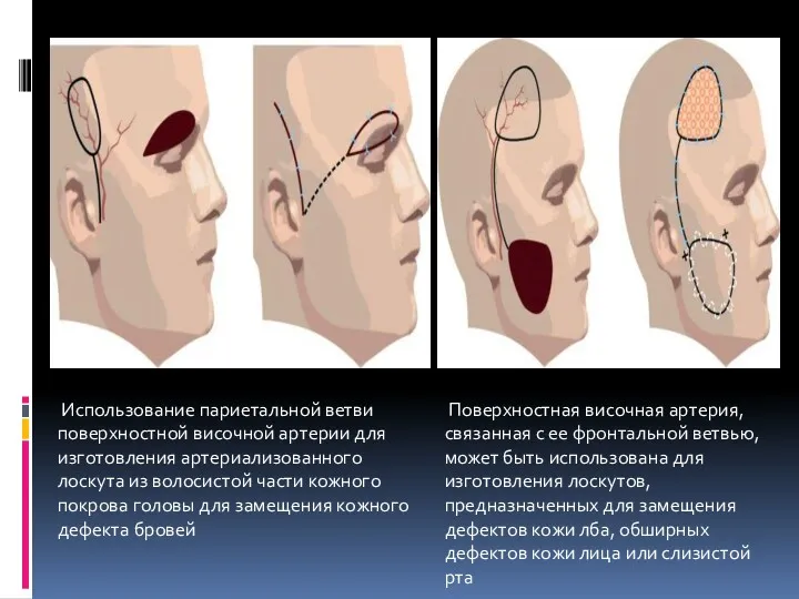 Использование париетальной ветви поверхностной височной артерии для изготовления артериализованного лоскута