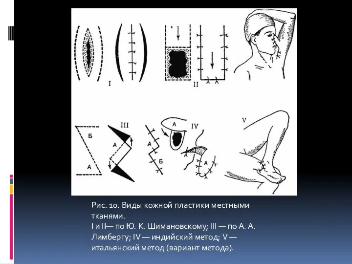 Рис. 10. Виды кожной пластики местными тканями. I и II—