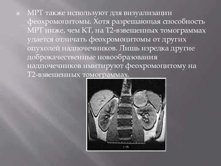 МРТ также используют для визуализации феохромоцитомы. Хотя разрешающая способность МРТ