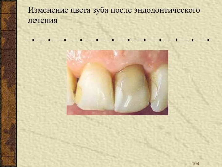 Изменение цвета зуба после эндодонтического лечения