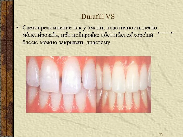 Durafill VS Светопреломнение как у эмали, пластичность,легко моделировать, при полировке достигается хорошй блеск, можно закрывать диастему.