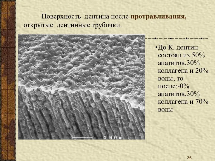 Поверхность дентина после протравливания, открытые дентинные трубочки. До К. дентин