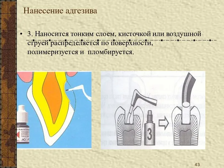 Нанесение адгезива 3. Наносится тонким слоем, кисточкой или воздушной струей распределяется по поверхности, полимеризуется и пломбируется.