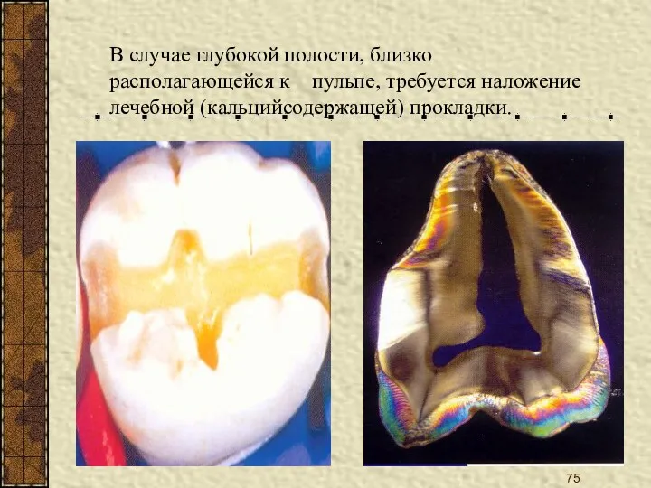 В случае глубокой полости, близко располагающейся к пульпе, требуется наложение лечебной (кальцийсодержащей) прокладки.