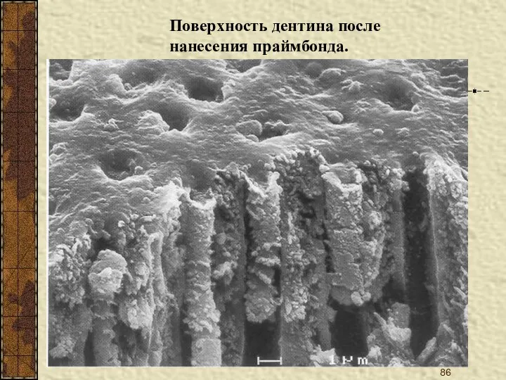 Поверхность дентина после нанесения праймбонда.