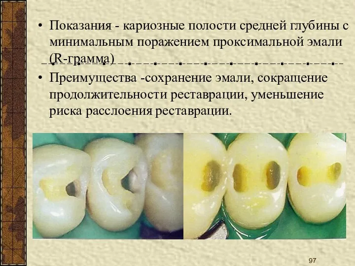 Показания - кариозные полости средней глубины с минимальным поражением проксимальной