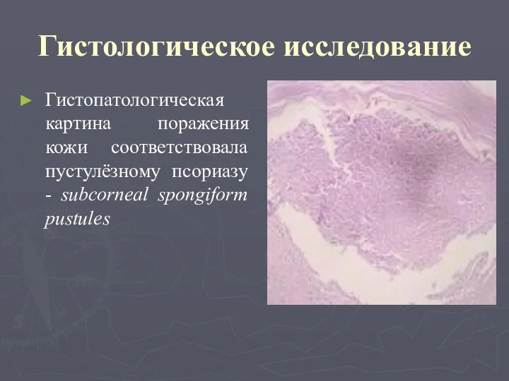 Гистологическое исследование Гистопатологическая картина поражения кожи соответствовала пустулёзному псориазу - subcorneal spongiform pustules