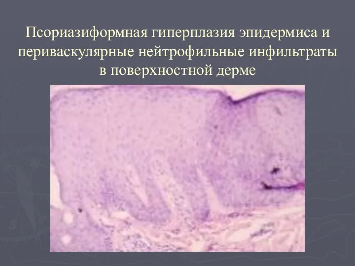 Псориазиформная гиперплазия эпидермиса и периваскулярные нейтрофильные инфильтраты в поверхностной дерме