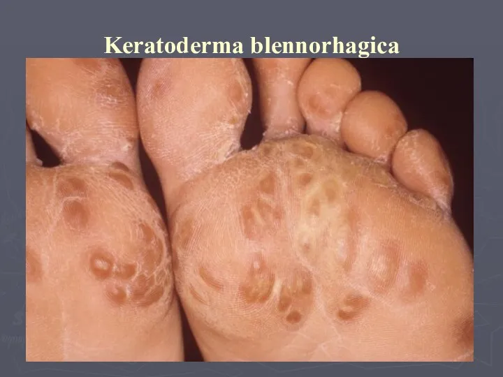 Keratoderma blennorhagica