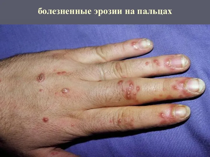 болезненные эрозии на пальцах