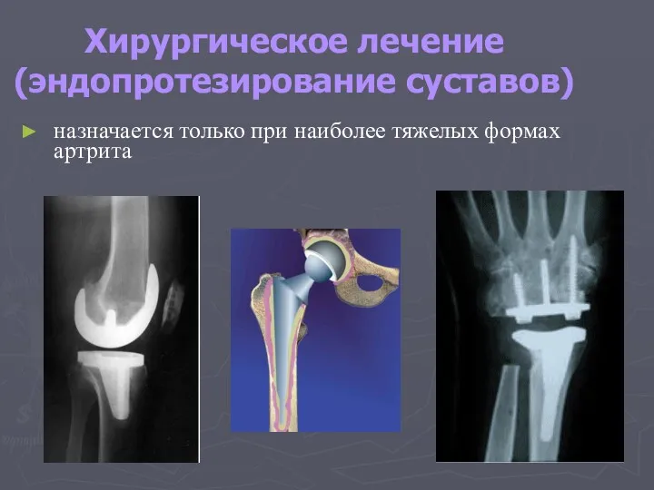 Хирургическое лечение (эндопротезирование суставов) назначается только при наиболее тяжелых формах артрита
