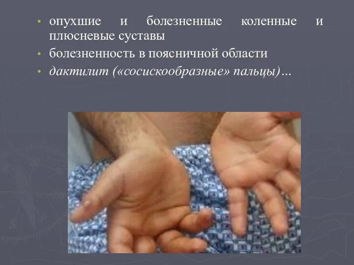 опухшие и болезненные коленные и плюсневые суставы болезненность в поясничной области дактилит («сосискообразные» пальцы)…
