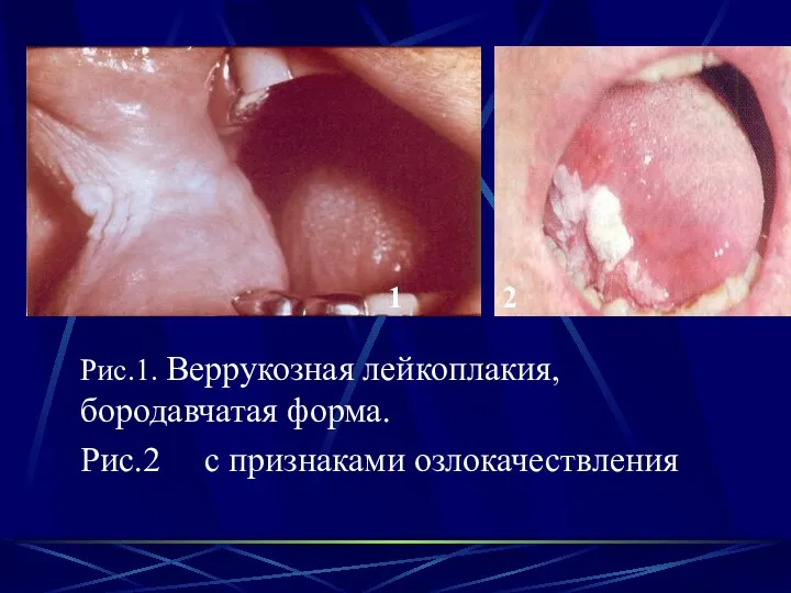 Рис.1. Веррукозная лейкоплакия, бородавчатая форма. Рис.2 с признаками озлокачествления 1 2