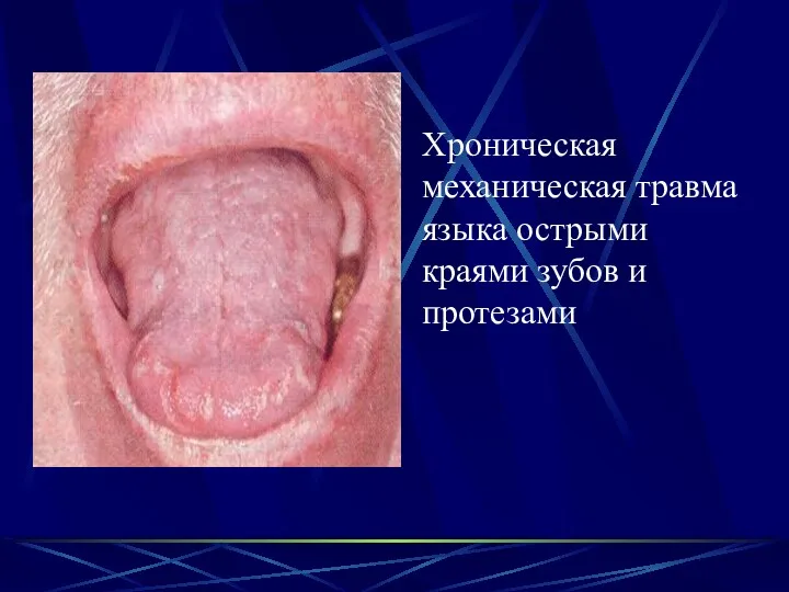 Хроническая механическая травма языка острыми краями зубов и протезами