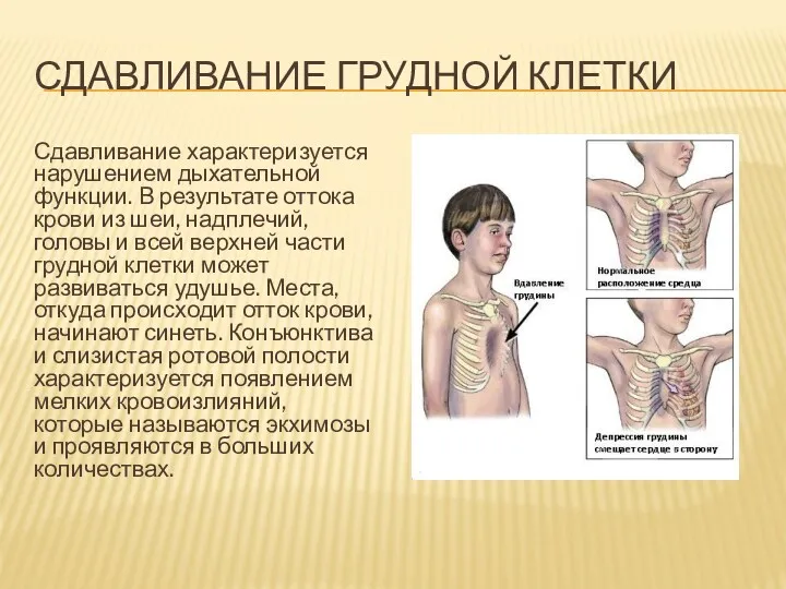 СДАВЛИВАНИЕ ГРУДНОЙ КЛЕТКИ Сдавливание характеризуется нарушением дыхательной функции. В результате