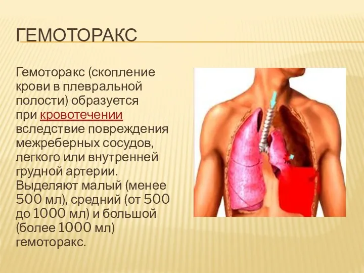 ГЕМОТОРАКС Гемоторакс (скопление крови в плевральной полости) образуется при кровотечении