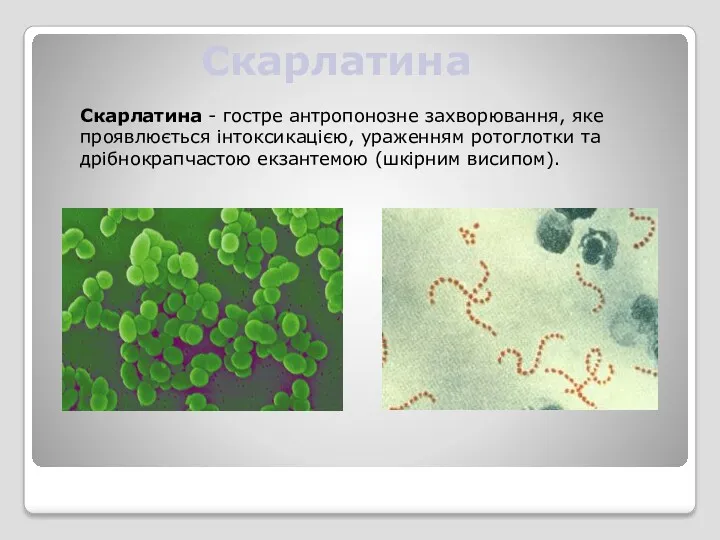 Скарлатина Скарлатина - гостре антропонозне захворювання, яке проявлюється інтоксикацією, ураженням ротоглотки та дрібнокрапчастою екзантемою (шкірним висипом).