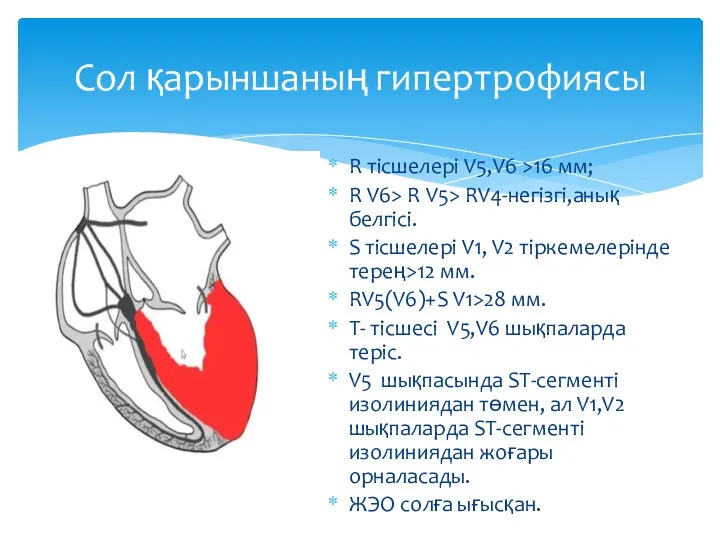 R тісшелері V5,V6 >16 мм; R V6> R V5> RV4-негізгі,анық