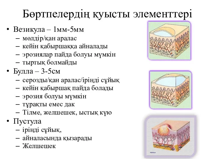 Бөртпелердің қуысты элементтері Везикула – 1мм-5мм мөлдір/қан аралас кейін қабыршаққа