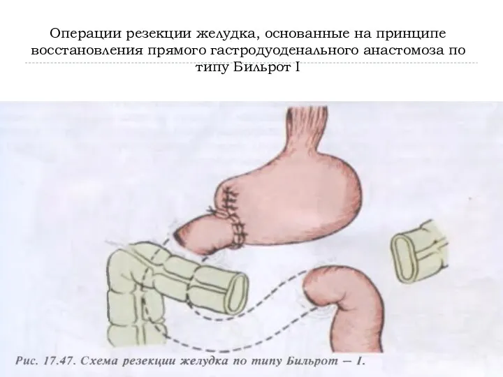 Операции резекции желудка, основанные на принципе восстановления прямого гастродуоденального анастомоза по типу Бильрот I