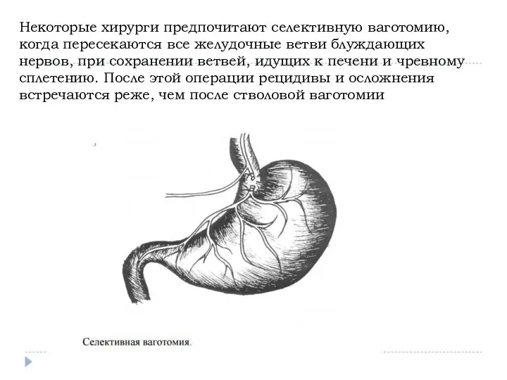 Некоторые хирурги предпочитают селективную ваготомию, когда пересекаются все желудочные ветви