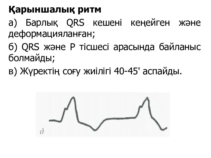 Қарыншалық ритм а) Барлық QRS кешені кеңейген және деформацияланған; б)