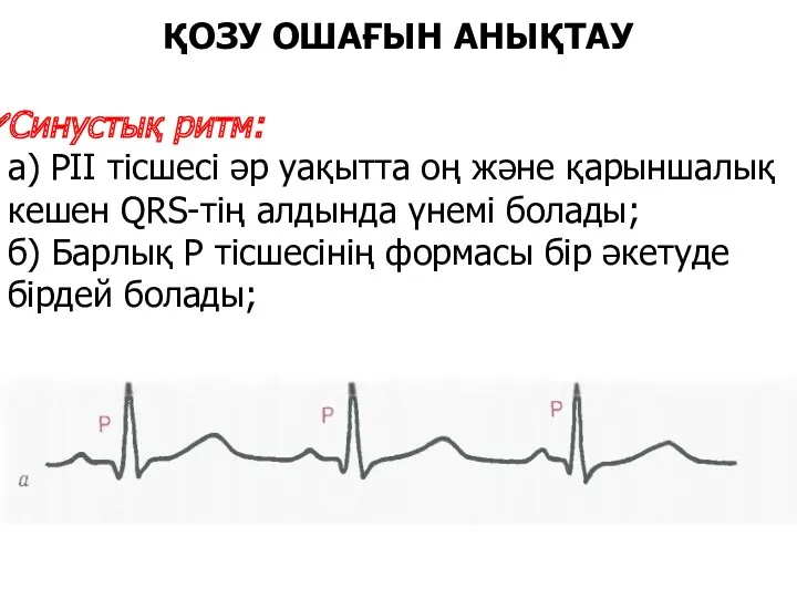 ҚОЗУ ОШАҒЫН АНЫҚТАУ Синустық ритм: а) РІІ тісшесі әр уақытта