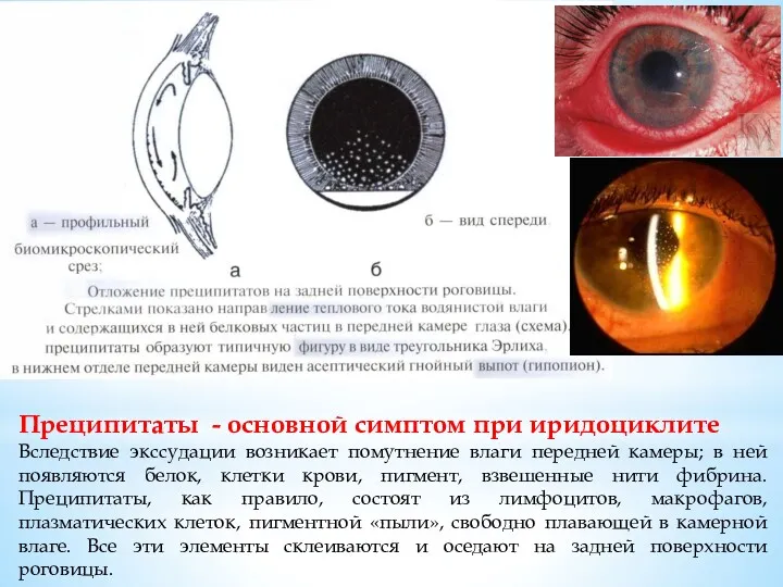 Преципитаты - основной симптом при иридоциклите Вследствие экссудации возникает помутнение