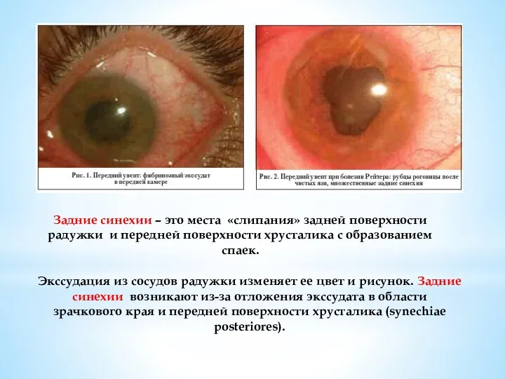 Экссудация из сосудов радужки изменяет ее цвет и рисунок. Задние