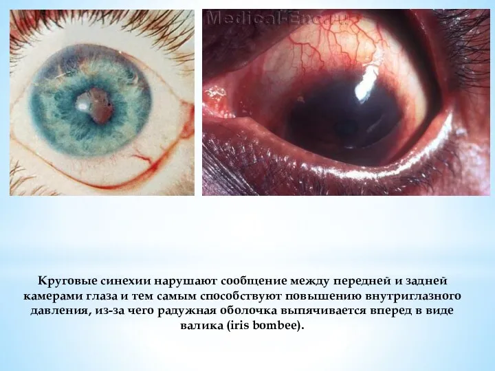 Круговые синехии нарушают сообщение между передней и задней камерами глаза