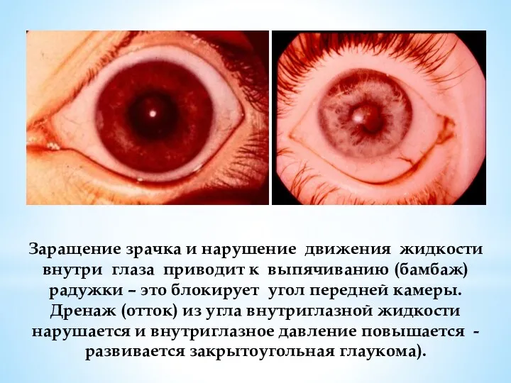 Заращение зрачка и нарушение движения жидкости внутри глаза приводит к